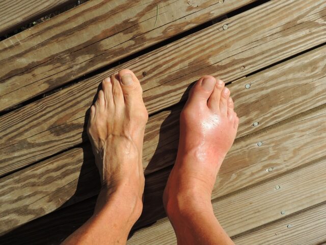 Tips on How to Manage Gout Flare-Ups
